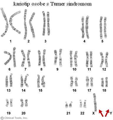 Kariotip osobe sa Turner sindromom