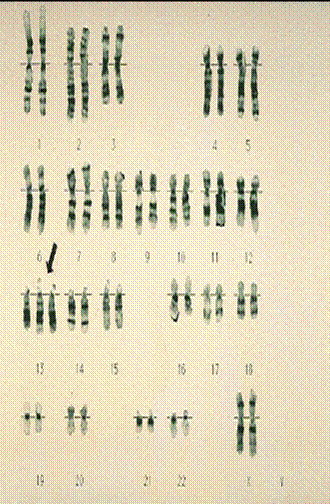 Kariotip osobe sa sindromom Patau