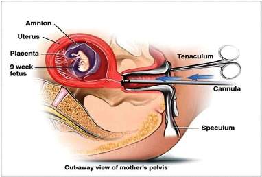 Abortus 