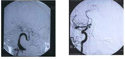 Angiografija krvnih suda glave i vrata