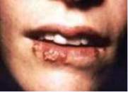 Herpes simplex