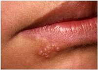 Herpes simplex