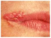 Labijalni herpes 