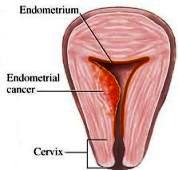 Rak endometrija