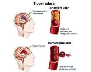 Tipovi mozdanog udara