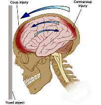 Contusio cerebri 