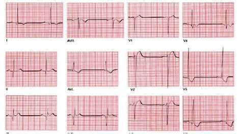 Elektrokardiogram (EKG)