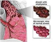 1.	Emfizem pluca