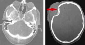 Fractura cranii 