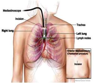 Medijastinoskopija 