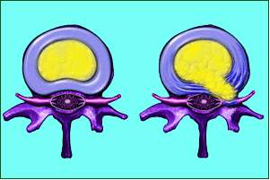 DISCUS HERNIA